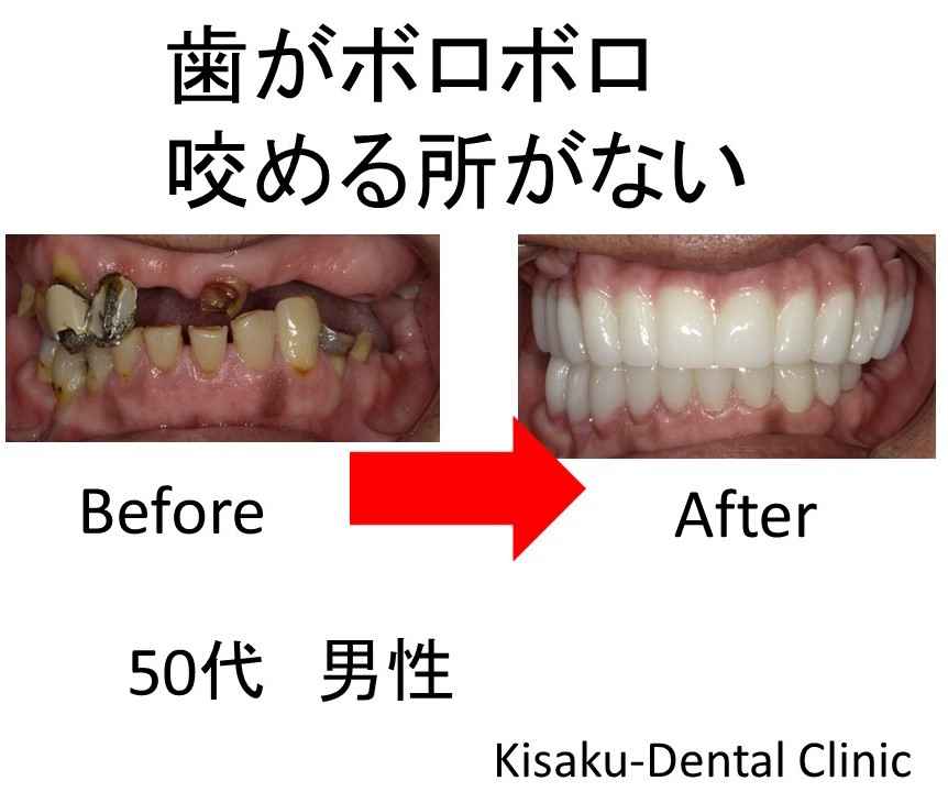 歯がボロボロ 咬める所がない ー50代 男性ーインプラント